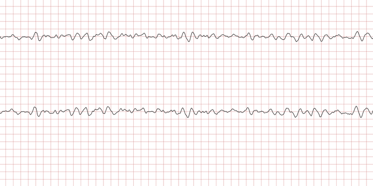EKG 8 (Fall 2): Kammerflimmern