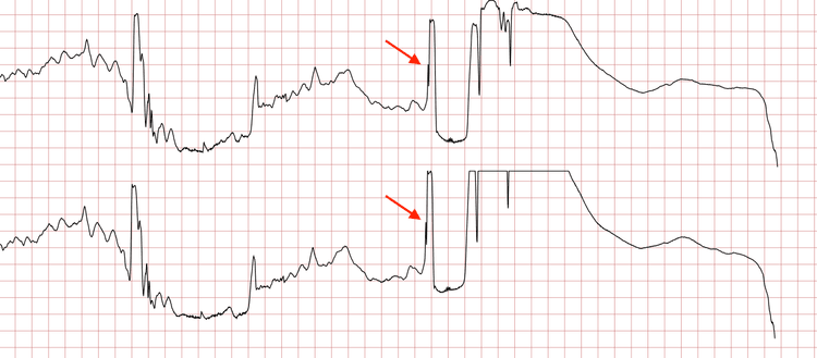 EKG 9 (Fall 2): Schockabgabe (roter Pfeil) mit nachfolgender Asystolie