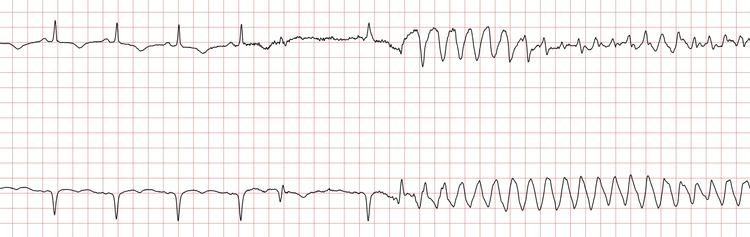 EKG 1 (Fall 3): Sinusrhythmus, unterbrochen durch eine ventrikuläre Tachykardie (VT)