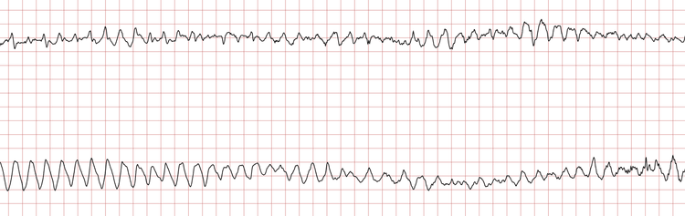 EKG 2 (Fall 3): Ventrikuläre Tachykardie (VT)