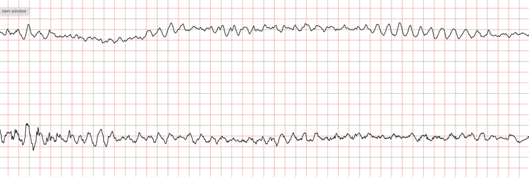 EKG 3 (Fall 3): Kammerflimmern