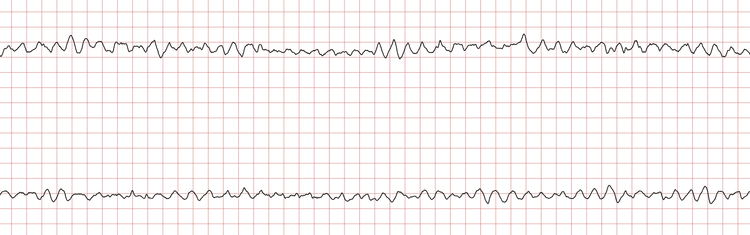 EKG 4 (Fall 3): Kammerflimmern