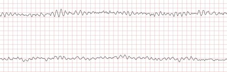 EKG 5 (Fall 3): Kammerflimmern