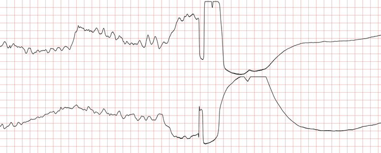 EKG 6 (Fall 3): Schockabgabe, gefolgt von Asystolie