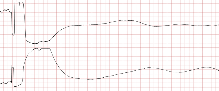 EKG 7 (Fall 3): Asystolie nach dem Schock