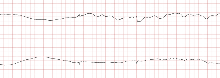 EKG 8 (Fall 3): Wiederkehr eines supraventrikulären Rhythmus