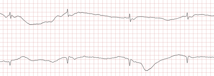 EKG 9 (Fall 3): Supraventrikulärer Rhythmus