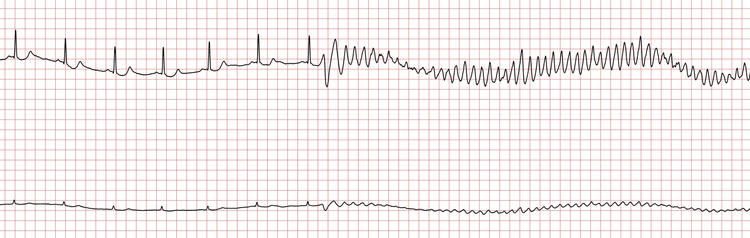 EKG 1 (Fall 5): Sinusrhythmus, unterbrochen durch eine polymorphe VT