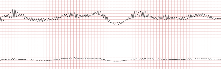 EKG 2 (Fall 5): Polymorphe VT