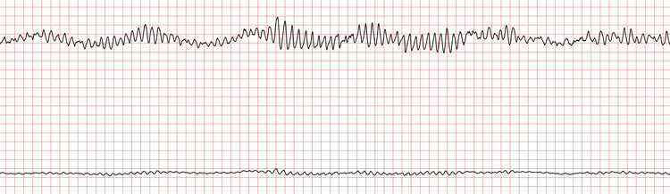 EKG 3 (Fall 5): Die polymorphe VT geht in Kammerflimmern über