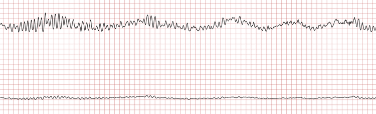 EKG 4 (Fall 5): Die polymorphe VT geht in Kammerflimmern über