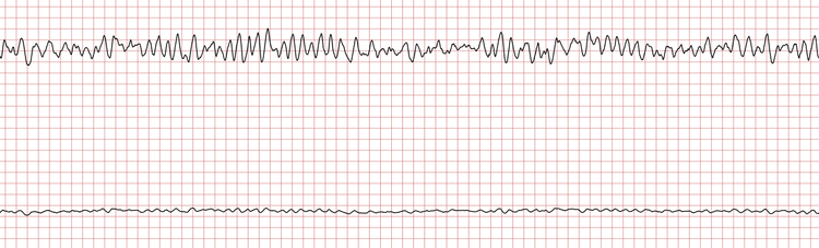 EKG 5 (Fall 5): Kammerflimmern