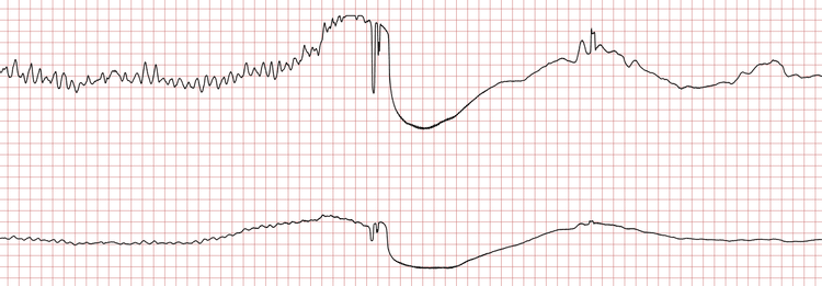 EKG 6 (Fall 5): Schockabgabe bei Kammerflimmern