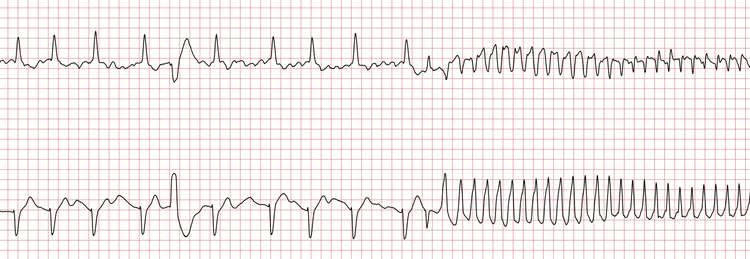 EKG 1 (Fall 6): Der Grundrhythmus ist Vorhofflimmern