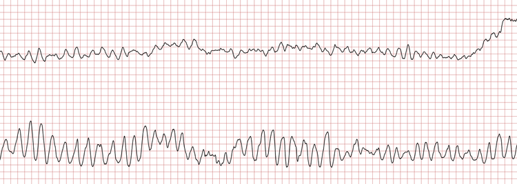 EKG 2 (Fall 6): Obwohl das Signal in der oberen Ableitung sehr desorganisiert wirkt, sind QRS-Komplexe erkennbar