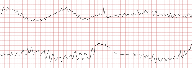 EKG 3 (Fall 6): Fortbestehende polymorphe ventrikuläre Tachykardie bzw