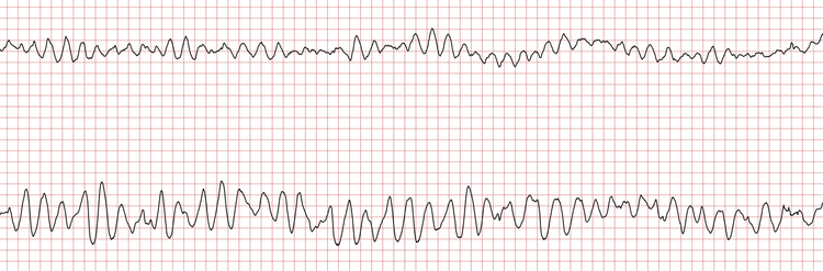 EKG 4 (Fall 6): Fortbestehende polymorphe ventrikuläre Tachykardie bzw