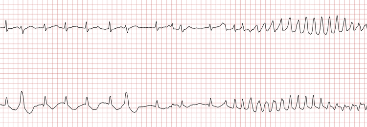 EKG 1 (Fall 7): Der Grundrhythmus ist Vorhofflimmern, unterbrochen durch eine polymorphe ventrikuläre Tachykardie (VT)