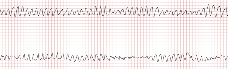 EKG 2 (Fall 7): Polymorphe ventrikuläre Tachykardie