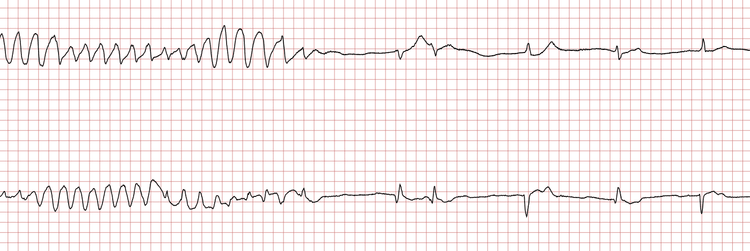EKG 3 (Fall 7): Spontane Terminierung der ventrikulären Tachykardie