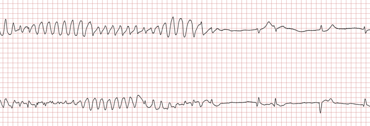 EKG 4 (Fall 7): Rezidiv und spontane Terminierung der ventrikulären Tachykardie
