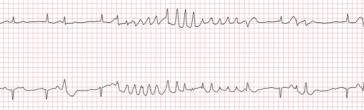 EKG 5 (Fall 7): Polymorphe ventrikuläre Tachykardie, selbstterminierend