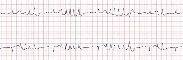 EKG 6 (Fall 7): Wiederholte Salven einer ventrikulären Tachykardie