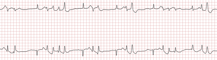 EKG 7 (Fall 7): Fortbestehende ventrikuläre Ektopie und VT