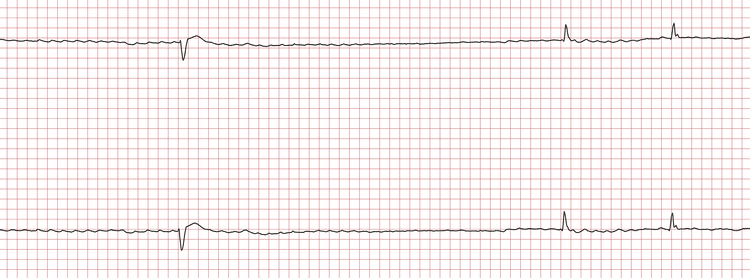 EKG 1 (Fall 8): Es liegt Vorhofflimmern vor