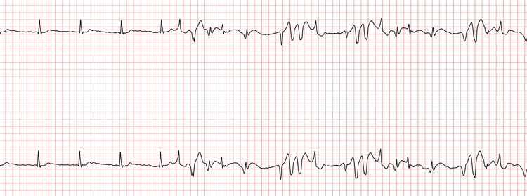 EKG 2 (Fall 8): Der erste Abschnitt zeigt QRS-Komplexe mit ähnlicher Morphologie wie in EKG 1, vermutlich ein supraventrikulärer Rhythmus