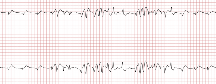 EKG 3 (Fall 8): Wiederholte Salven einer VT