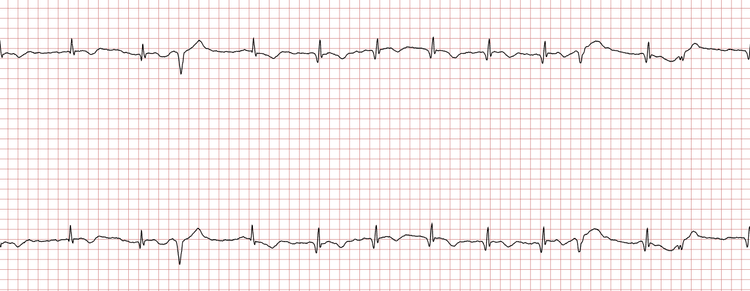 EKG 4 (Fall 8): Jetzt sind ST-Strecken-Hebungen und Q-Zacken sichtbar, die in der ersten Registrierung (EKG 1) nicht vorhanden waren