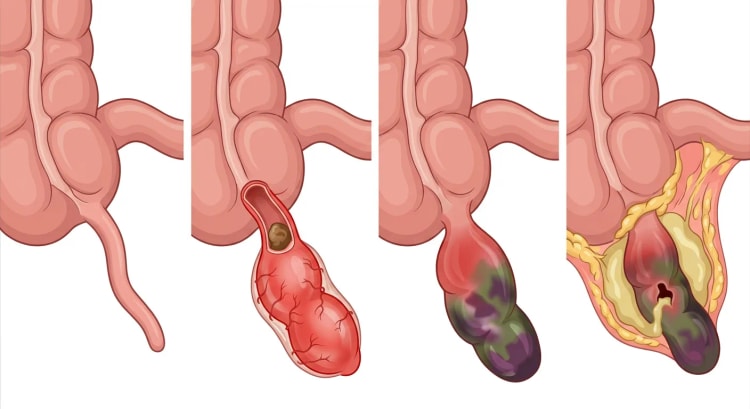 Vier Darstellungen des Zäkums mit Appendix: normal, entzündet mit Fäkolith, gangränös und perforiert mit Abszess, umgeben von Omentum.