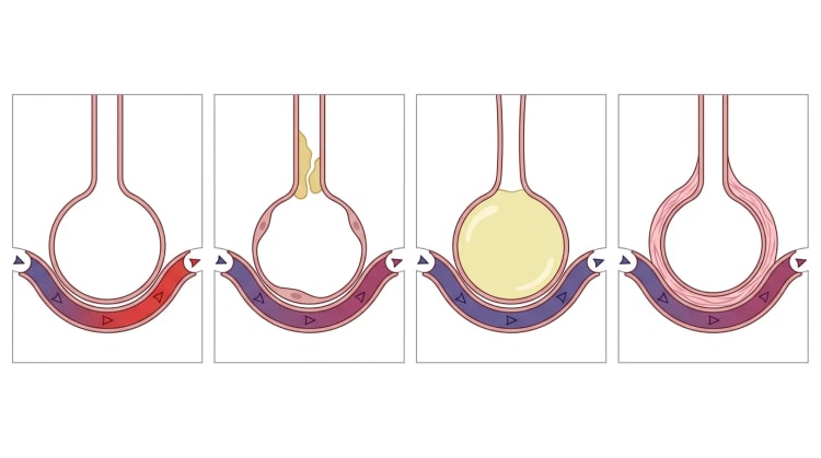 Vier schematische Alveolen mit Kapillaren: normal, schleimverlegter Atemweg, flüssigkeitsgefüllte Alveole und verdickte Alveolarwand, mit Blutfarbe von Blau nach Rot oder unverändert.