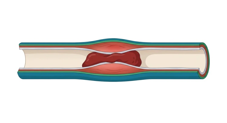 Längsschnitt durch eine Vene mit eröffnetem Lumen. Die Gefäßwand ist im mittleren Abschnitt verdickt und gerötet, und ein dunkelroter Thrombus haftet breitbasig an der Wand, während das Gefäß beiderseits des Thrombus offen ist.