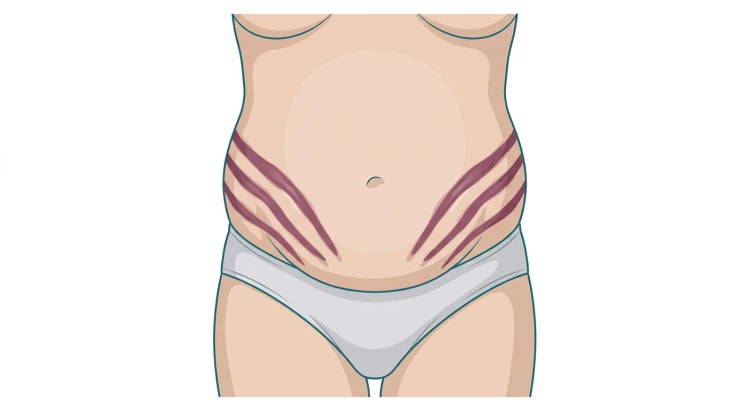 Gezeichneter unterer Rumpf von vorn bei einer Person mit abdomineller Adipositas. An beiden Flanken und am Unterbauch zeigen sich mehrere breite, rotviolette Striae in parallelen, schräg nach unten verlaufenden Bändern.