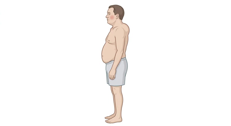 Gezeichneter Mann im Profil mit rundem, vollem Gesicht und geröteter Wange, kurzem und breitem Hals, massiver stammbetonter Adipositas sowie auffallend schlanken Armen und Beinen.
