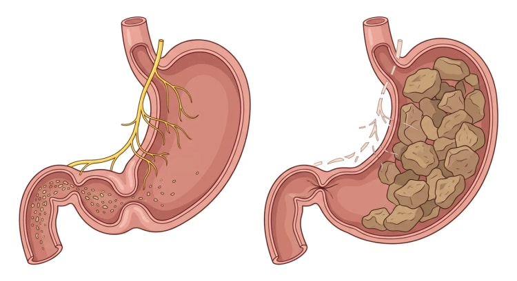 Zwei Mägen nebeneinander: einer normal mit intaktem Nervus vagus, antraler Kontraktion und offenem Pylorus, und einer bei Gastroparese mit geschädigten Nervenästen, verbliebener fester Nahrung und geschlossenem Pylorus.