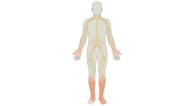 Ganzkörperansicht von vorn mit peripheren Nerven in Gelb. Füße, Unterschenkel und Hände sind rötlich getönt, und die Nervenenden in Zehen und Fingern sind fragmentiert.