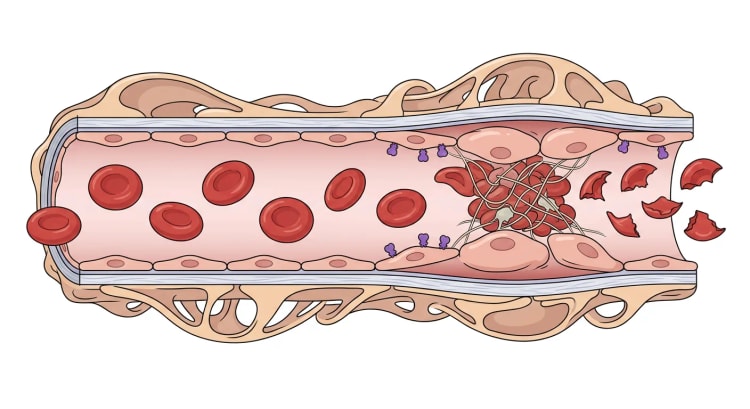 Aufgeschnittene glomeruläre Kapillare, in der gesunde Endothelwand und intakte Erythrozyten in geschwollenes, geschädigtes Endothel mit gebundenem Toxin, einen thrombozyten- und fibrinreichen Mikrothrombus und stromabwärts fragmentierte Erythrozyten übergehen.