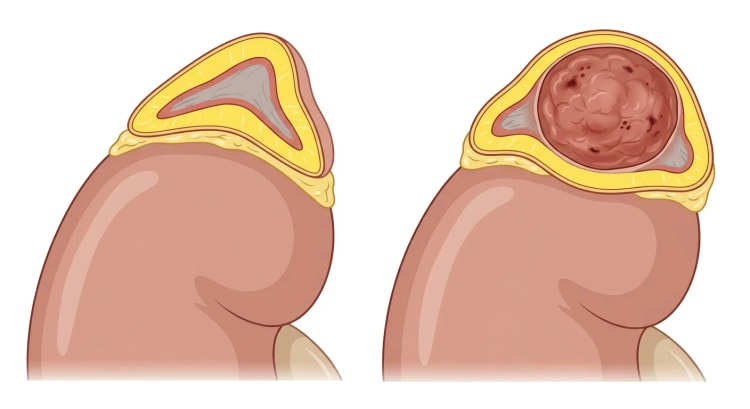 Querschnitt einer Nebenniere auf dem oberen Nierenpol: links normale Nebenniere mit gelber Rinde und grauem Mark, rechts ein runder rotbrauner Tumor im Mark, umgeben von gedehnter Rinde.