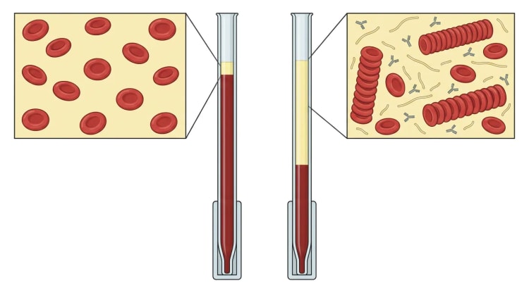 Zwei Westergren-Röhrchen mit vergrößerten Blutausschnitten: links frei schwebende Erythrozyten und eine dünne Plasmaschicht, rechts Geldrollenaggregate zwischen Fibrinogen und Antikörpern und eine deutlich höhere Plasmaschicht.