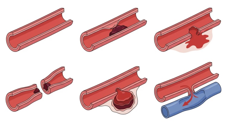 Sechs aufgeschnittene Arteriensegmente, die eine normale Arterie und fünf Typen traumatischer Arterienverletzung zeigen.