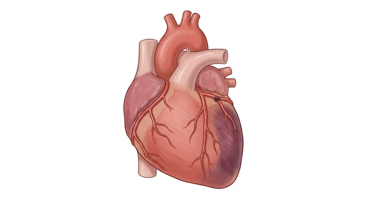 Herz von vorn mit einem Thrombus im Ramus circumflexus der linken Koronararterie und einem dunkel gefärbten Infarktareal in der lateralen Wand des linken Ventrikels.