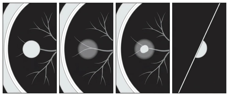 Vier schematische CT-Ausschnitte der Lunge im Lungenfenster: solider Rundherd, reiner Milchglasrundherd, teilsolider Rundherd und perifissuraler Rundherd.