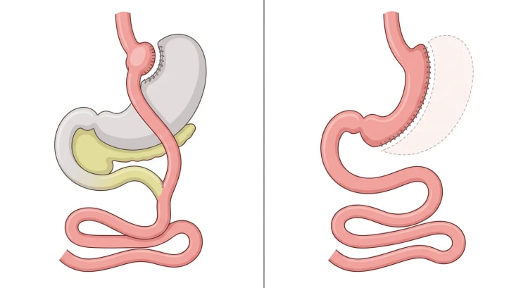 Zwei Bildtafeln des Magen-Darm-Trakts: links die Anatomie nach Roux-en-Y-Magenbypass, rechts nach Sleeve-Gastrektomie.