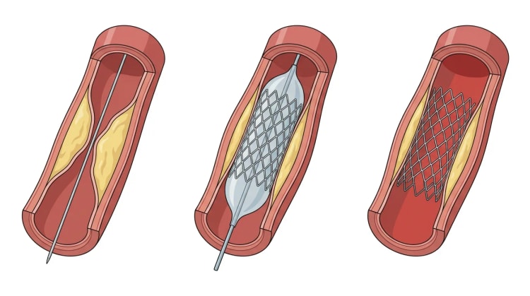 Drei aufgeschnittene Koronararteriensegmente mit Stenose und Führungsdraht, aufgeblasenem Ballon mit Stent und verbleibendem expandiertem Stent.