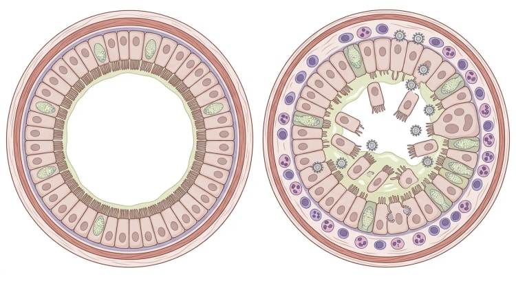 Querschnitt einer gesunden Bronchiole neben einer RSV-infizierten Bronchiole mit verlorenen Zilien, abgeschilferten Epithelzellen, Schleim, Entzündungszellen und eingeengtem Lumen.