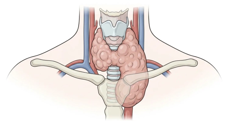 Hals von vorn mit einer stark und asymmetrisch vergrößerten, knotigen Schilddrüse, deren einer Lappen hinter das Manubrium hinabreicht und auf die Trachea drückt.