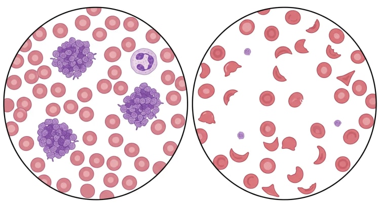 Zwei mikroskopische Gesichtsfelder von Blutausstrichen. Links normale Erythrozyten, ein Neutrophiler und drei große Thrombozytenklumpen. Rechts fragmentierte Erythrozyten und vereinzelte freie Thrombozyten.